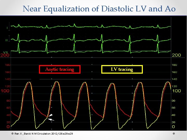 Near Equalization of Diastolic LV and Ao Aortic tracing Ren X , Banki N