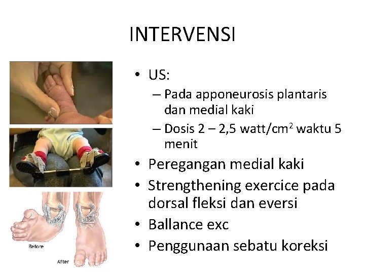 INTERVENSI • US: – Pada apponeurosis plantaris dan medial kaki – Dosis 2 –