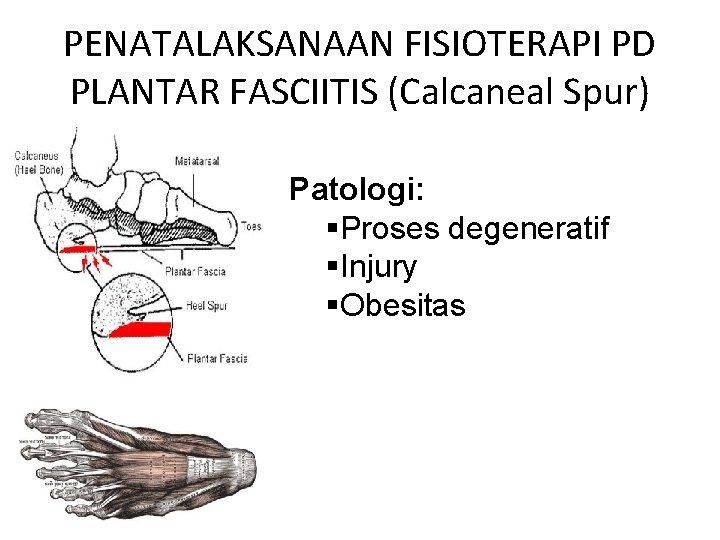 PENATALAKSANAAN FISIOTERAPI PD PLANTAR FASCIITIS (Calcaneal Spur) Patologi: §Proses degeneratif §Injury §Obesitas 