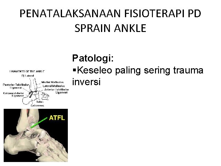 PENATALAKSANAAN FISIOTERAPI PD SPRAIN ANKLE Patologi: §Keseleo paling sering trauma inversi 