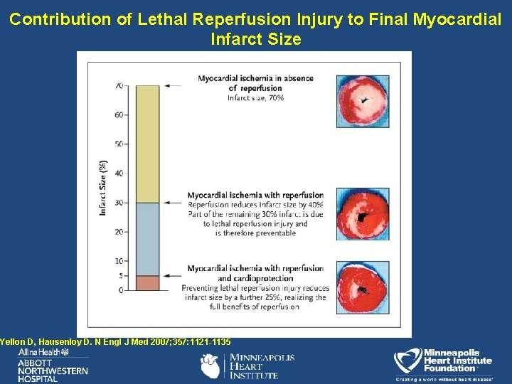 Contribution of Lethal Reperfusion Injury to Final Myocardial Infarct Size Yellon D, Hausenloy D.