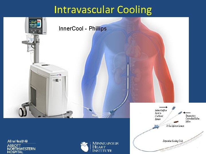 Intravascular Cooling Inner. Cool - Phillips 