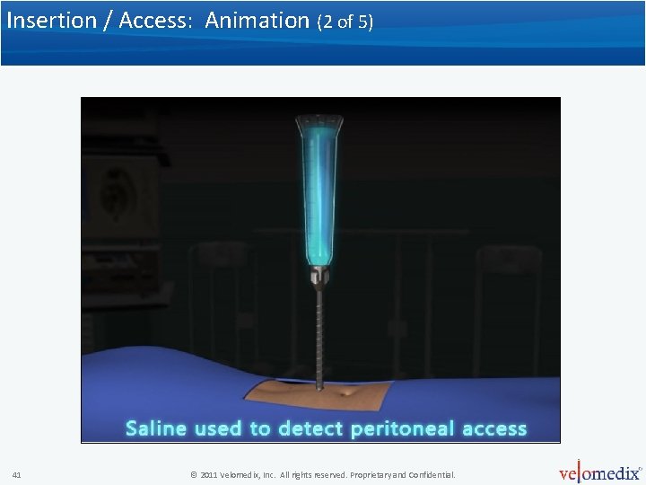 Insertion / Access: Animation (2 of 5) 41 © 2011 Velomedix, Inc. All rights Insertion / Access: Animation (2 of 5) 41 © 2011 Velomedix, Inc. All rights