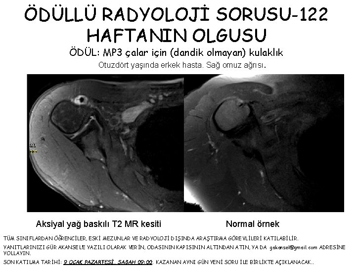 ÖDÜLLÜ RADYOLOJİ SORUSU-122 HAFTANIN OLGUSU ÖDÜL: MP 3 çalar için (dandik olmayan) kulaklık Otuzdört