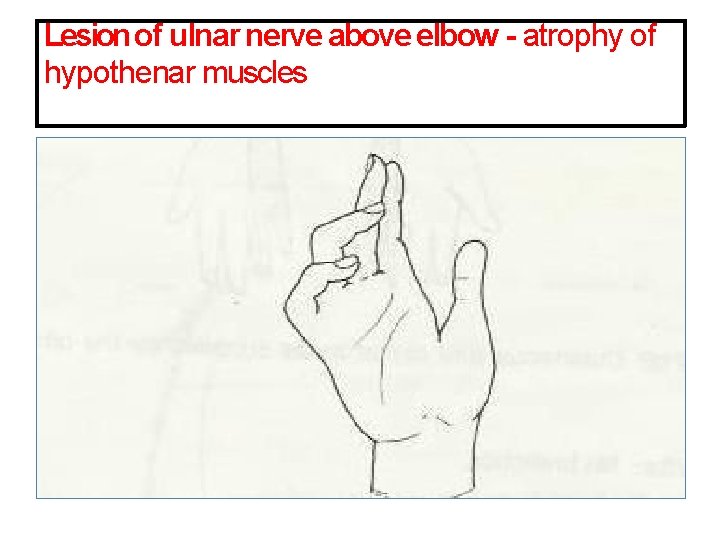 Lesion of ulnar nerve above elbow - atrophy of hypothenar muscles 