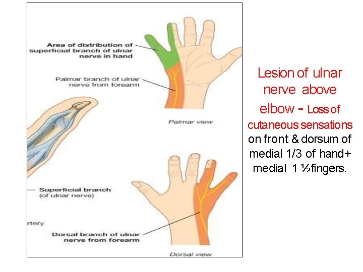 Lesion of ulnar nerve above elbow - Loss of cutaneous sensations on front &