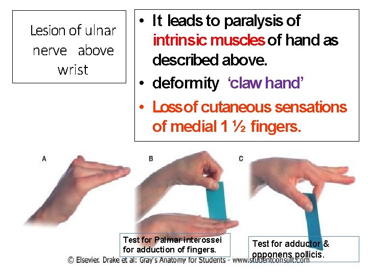 Lesion of ulnar nerve above wrist • It leads to paralysis of intrinsic muscles