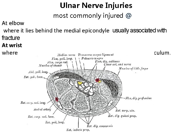 Ulnar Nerve Injuries most commonly injured @ At elbow where it lies behind the