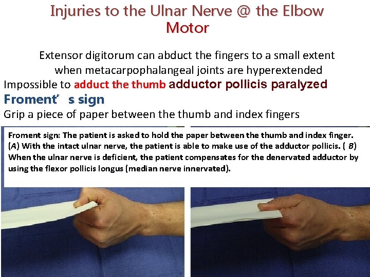 Injuries to the Ulnar Nerve @ the Elbow Motor Extensor digitorum can abduct the