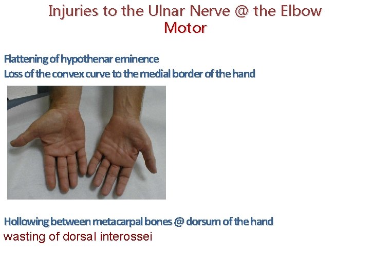 Injuries to the Ulnar Nerve @ the Elbow Motor Flattening of hypothenar eminence Loss