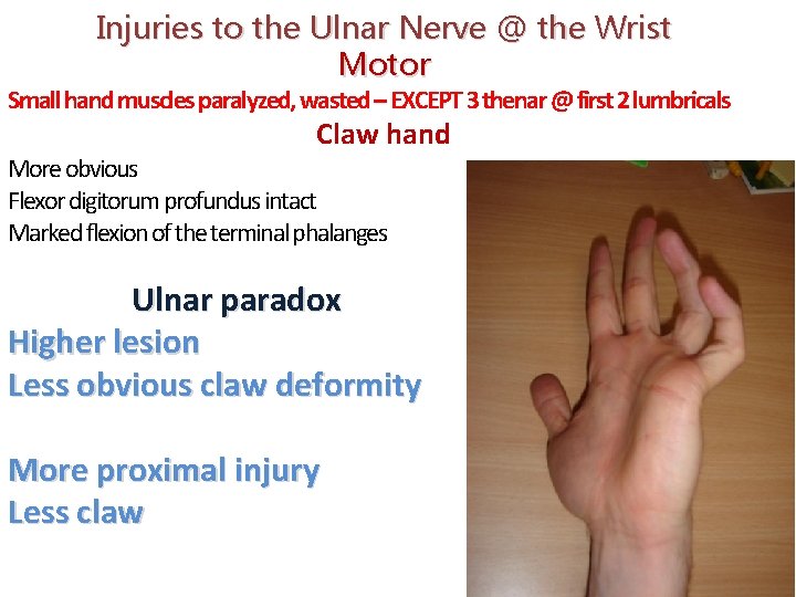 Injuries to the Ulnar Nerve @ the Wrist Motor Small hand muscles paralyzed, wasted