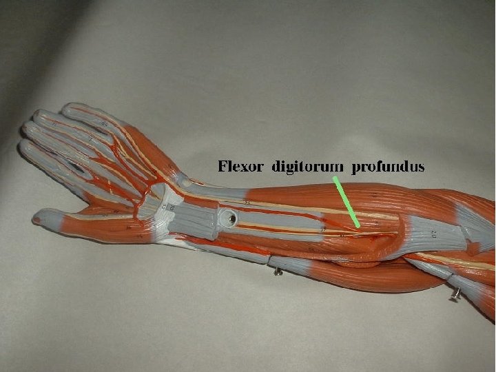 ULNAR NERVE ENTRAPMENT SYNDROMES PROXIMAL/ @ ELBOW CUBITAL TUNNEL SYNDROME BETWEEN MEDIAL EPICONDYLE &