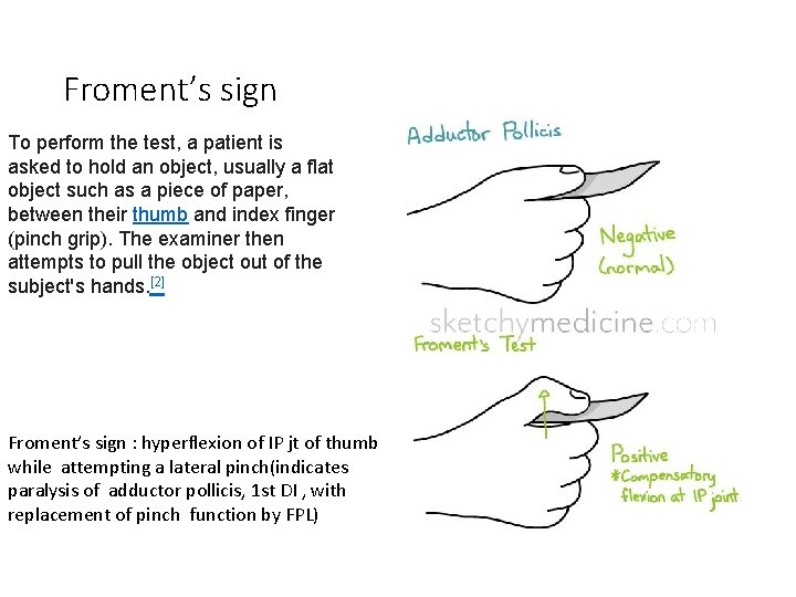 Froment’s sign To perform the test, a patient is asked to hold an object,