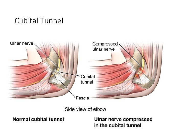 Cubital Tunnel 