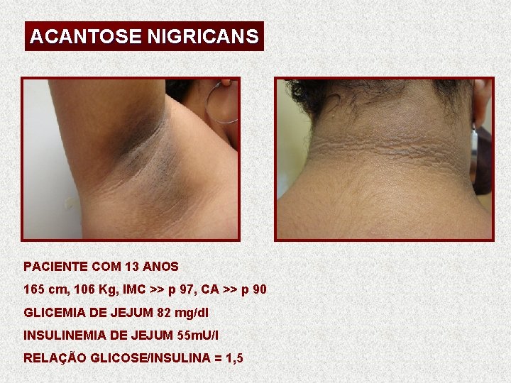ACANTOSE NIGRICANS PACIENTE COM 13 ANOS 165 cm, 106 Kg, IMC >> p 97,