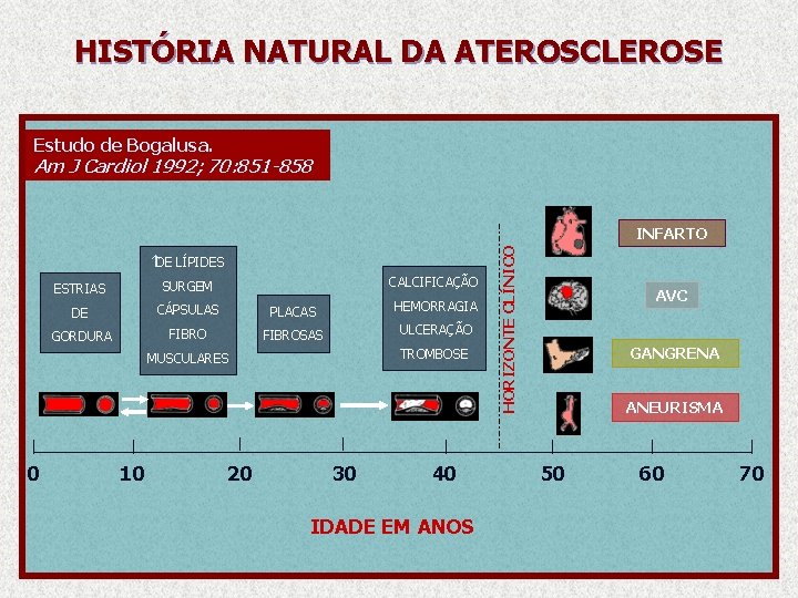 HISTÓRIA NATURAL DA ATEROSCLEROSE Estudo de Bogalusa. Am J Cardiol 1992; 70: 851 -858