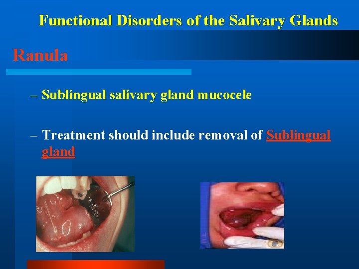 Functional Disorders of the Salivary Glands Ranula – Sublingual salivary gland mucocele – Treatment