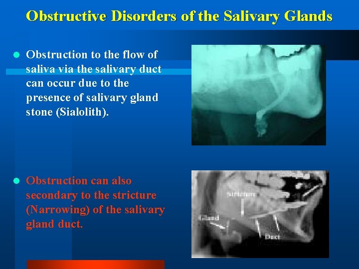 Obstructive Disorders of the Salivary Glands l Obstruction to the flow of saliva via