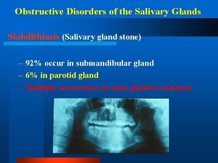 Obstructive Disorders of the Salivary Glands Sialolithiasis (Salivary gland stone) – 92% occur in