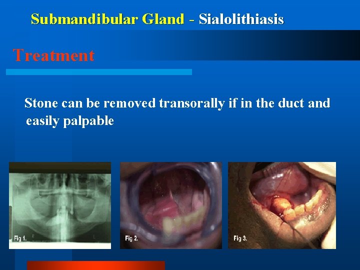 Submandibular Gland - Sialolithiasis Treatment Stone can be removed transorally if in the duct