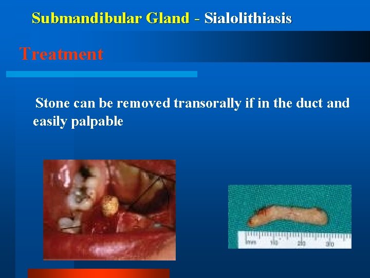 Submandibular Gland - Sialolithiasis Treatment Stone can be removed transorally if in the duct