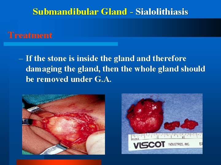 Submandibular Gland - Sialolithiasis Treatment – If the stone is inside the gland therefore