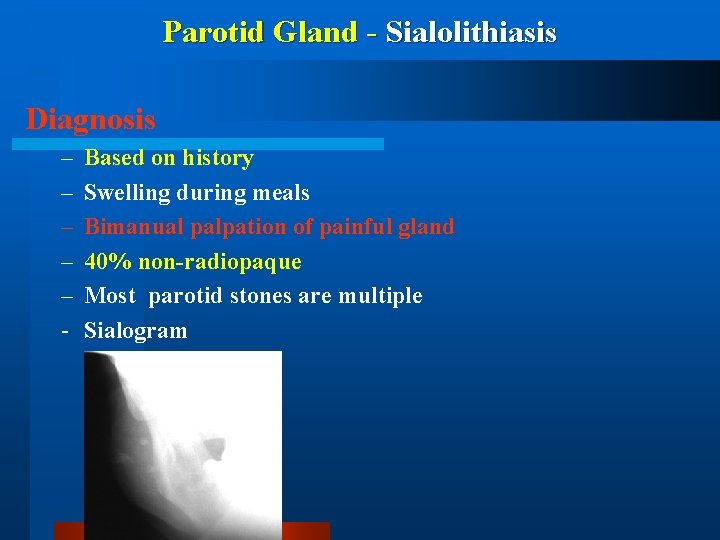 Parotid Gland - Sialolithiasis Diagnosis – – – - Based on history Swelling during