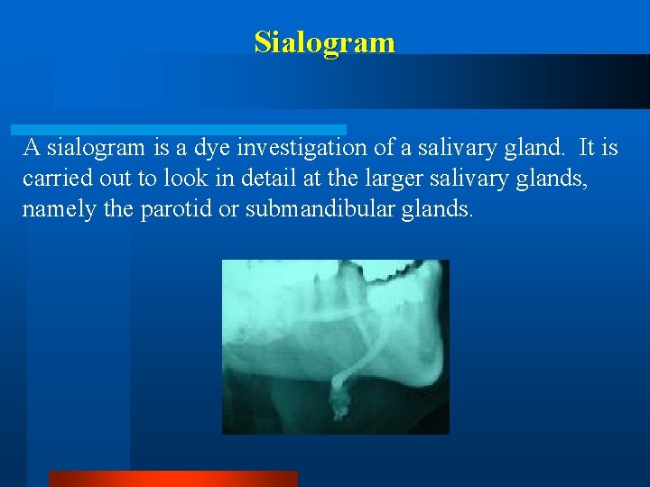 Sialogram A sialogram is a dye investigation of a salivary gland. It is carried