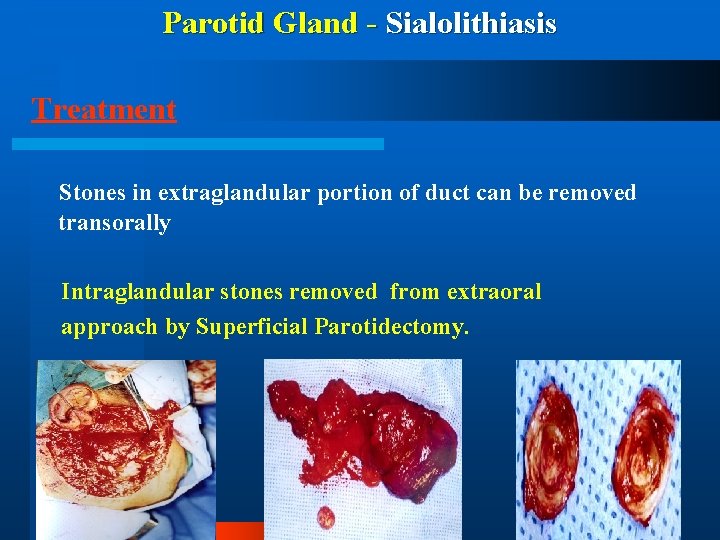 Parotid Gland - Sialolithiasis Treatment Stones in extraglandular portion of duct can be removed