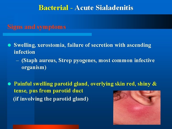 Bacterial - Acute Sialadenitis Signs and symptoms l Swelling, xerostomia, failure of secretion with
