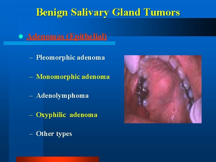 Benign Salivary Gland Tumors l Adenomas (Epithelial) – Pleomorphic adenoma – Monomorphic adenoma –