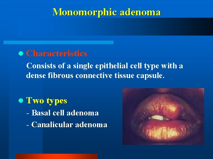 Monomorphic adenoma l Characteristics Consists of a single epithelial cell type with a dense