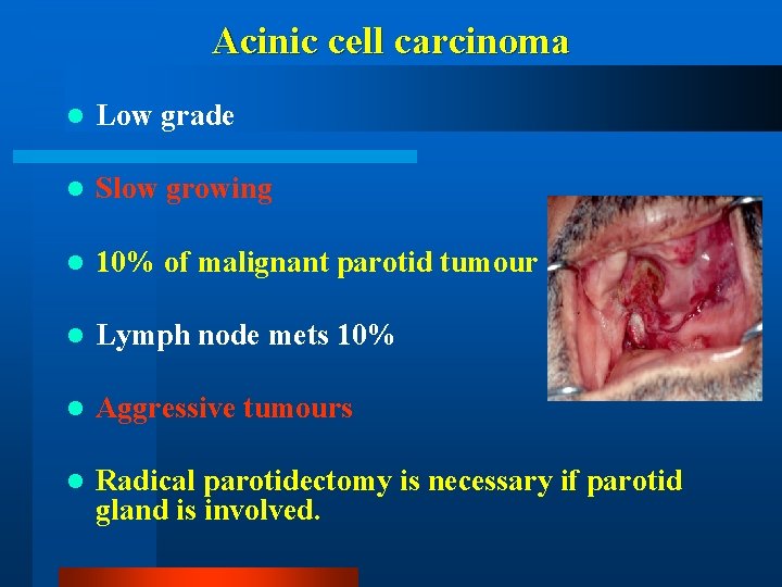 Acinic cell carcinoma l Low grade l Slow growing l 10% of malignant parotid