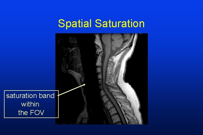 Spatial Saturation saturation band within the FOV 