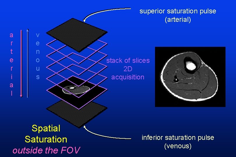 superior saturation pulse (arterial) a r t e r i a l v e
