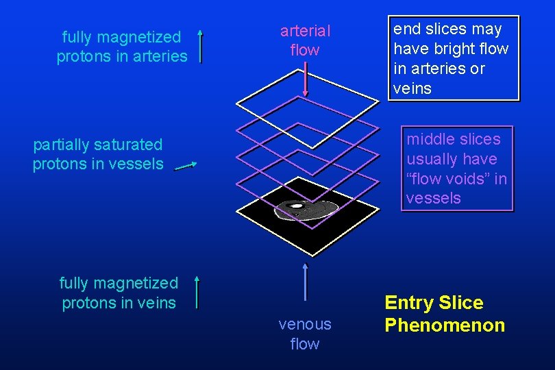 fully magnetized protons in arteries arterial flow end slices may have bright flow in