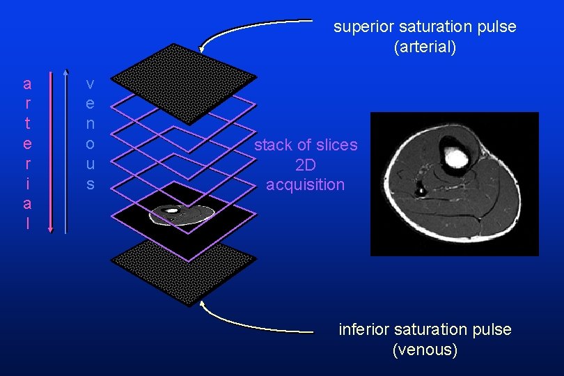 superior saturation pulse (arterial) a r t e r i a l v e