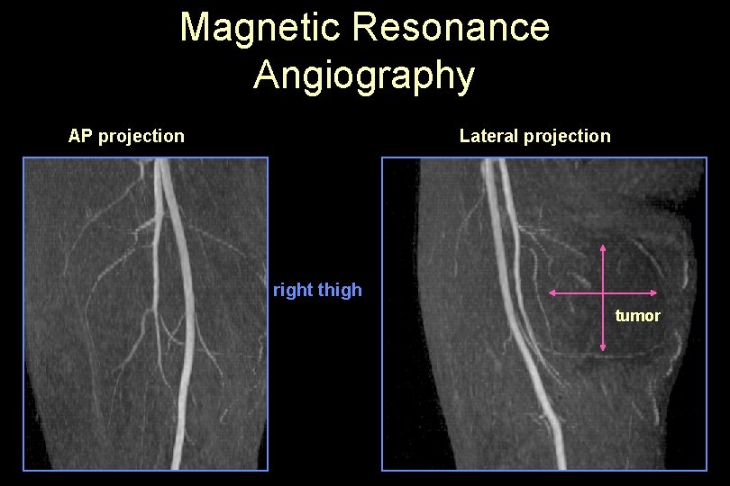 Magnetic Resonance Angiography AP projection Lateral projection right thigh tumor 