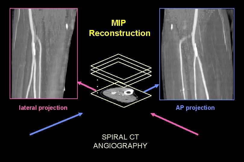 MIP Reconstruction . . . lateral projection AP projection SPIRAL CT ANGIOGRAPHY 
