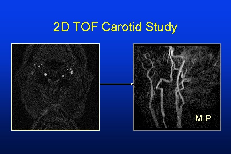 2 D TOF Carotid Study MIP 