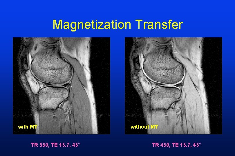 Magnetization Transfer with MT TR 550, TE 15. 7, 45° without MT TR 450,