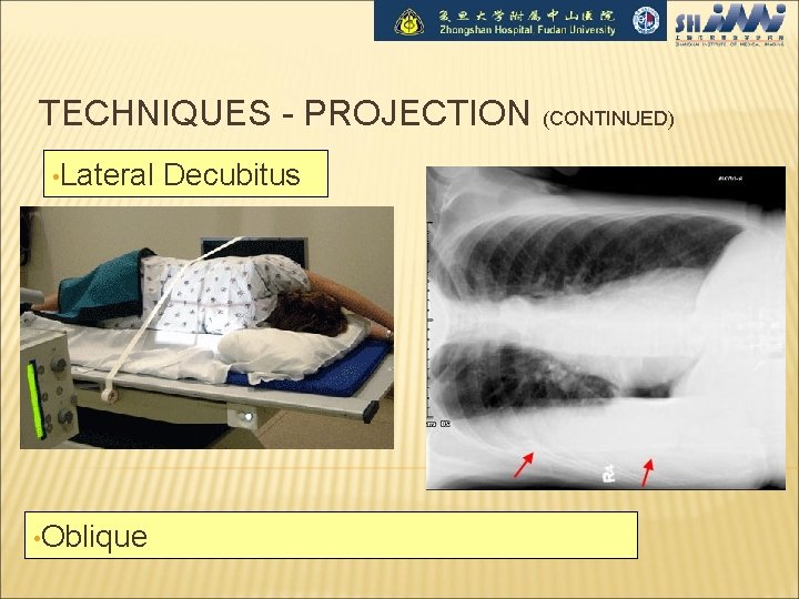 TECHNIQUES - PROJECTION (CONTINUED) • Lateral • Oblique Decubitus 