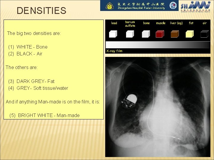 DENSITIES The big two densities are: (1) WHITE - Bone (2) BLACK - Air