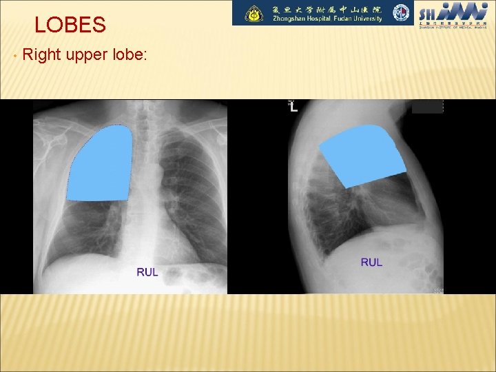 LOBES • Right upper lobe: 