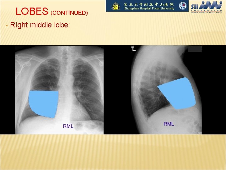 LOBES (CONTINUED) • Right middle lobe: 