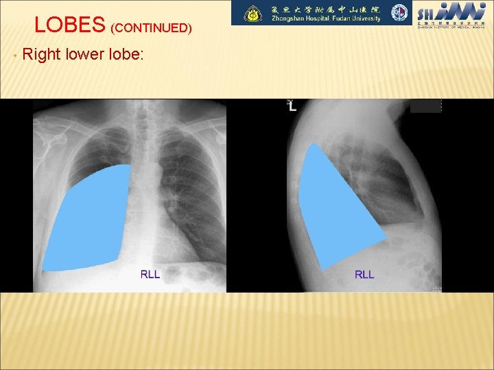 LOBES (CONTINUED) • Right lower lobe: 