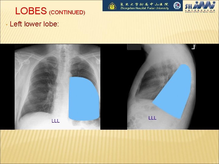 LOBES (CONTINUED) • Left lower lobe: 