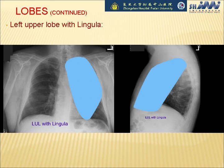 LOBES (CONTINUED) • Left upper lobe with Lingula: 