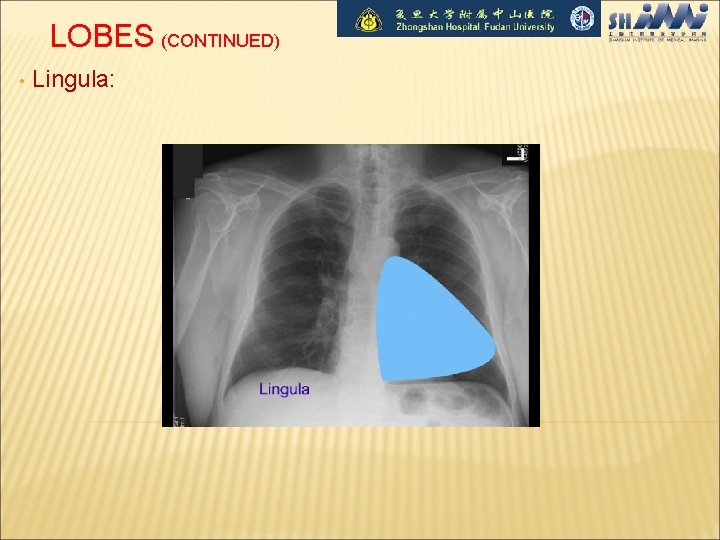LOBES (CONTINUED) • Lingula: 