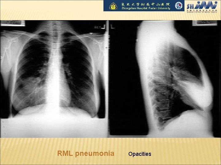 RML pneumonia Opacities 